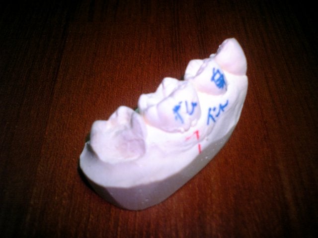 歯型の写真